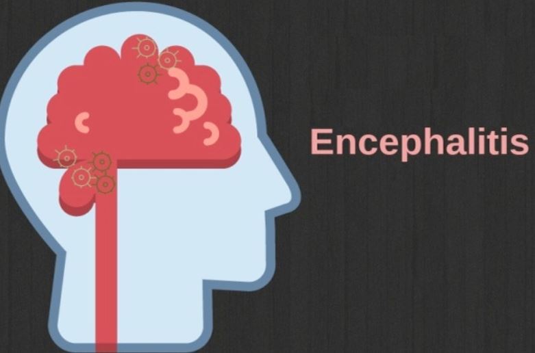 encephalities diagram